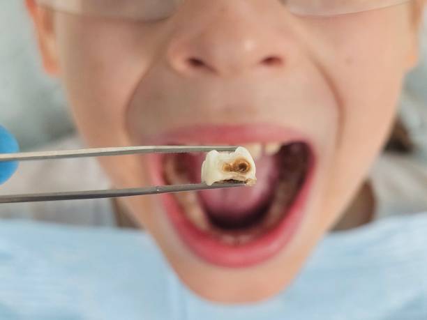 Best Knocked-Out Tooth (Avulsed Tooth) Treatment in Springdale, SC